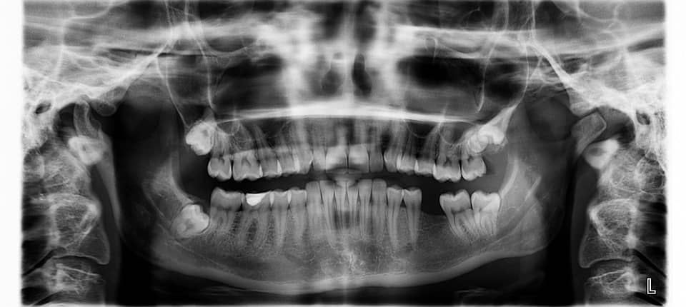 Opg x ray
